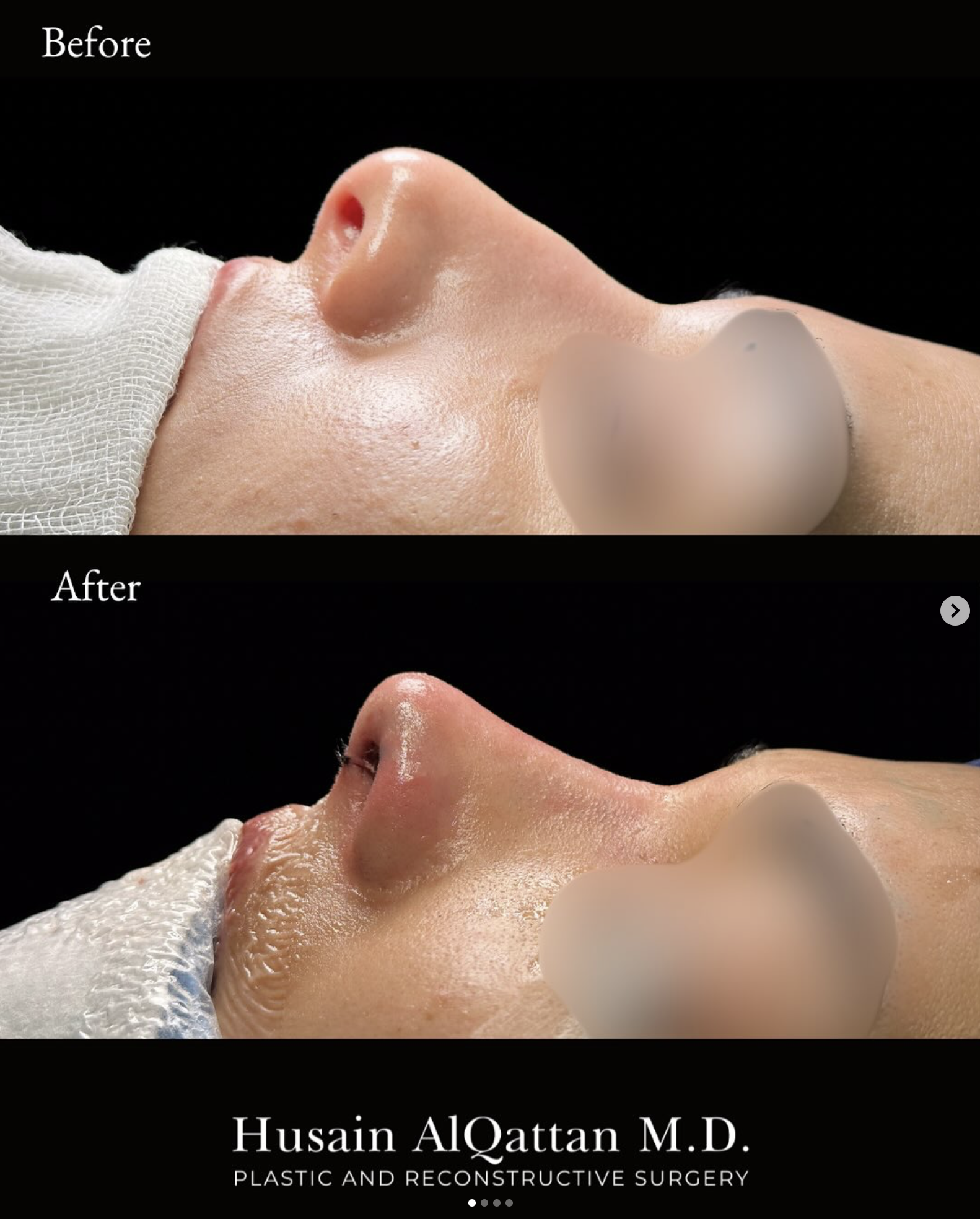 Before and after images of a person's nose showing the results of cosmetic surgery by Dr. Husain Alqattan, a plastic and reconstructive surgeon. The "before" image shows a nose with a deviated septum, and the "after" image shows a straighter nose.