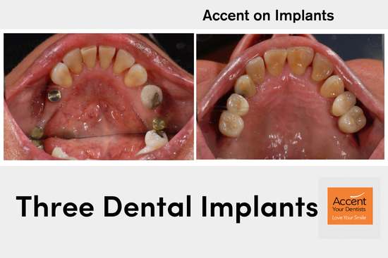 Restoring Three Missing Teeth: A Stronger, Beautiful Smile