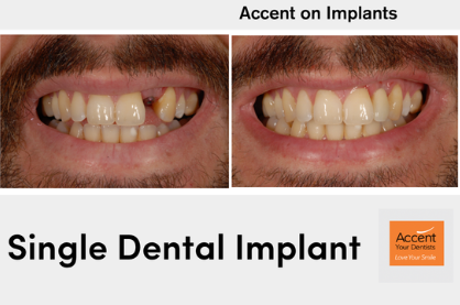 Single Impant Transformation 