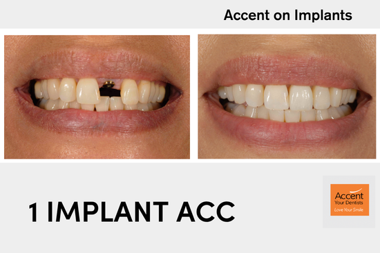 Before and after replacing a fractured root-filled tooth with a dental implant at Accent Your Dentist in Ponsonby, Auckland.