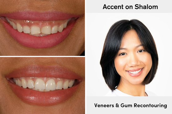 Before and after front teeth enhancement with porcelain dental veneers at Accent Your Dentist in Ponsonby, Auckland.