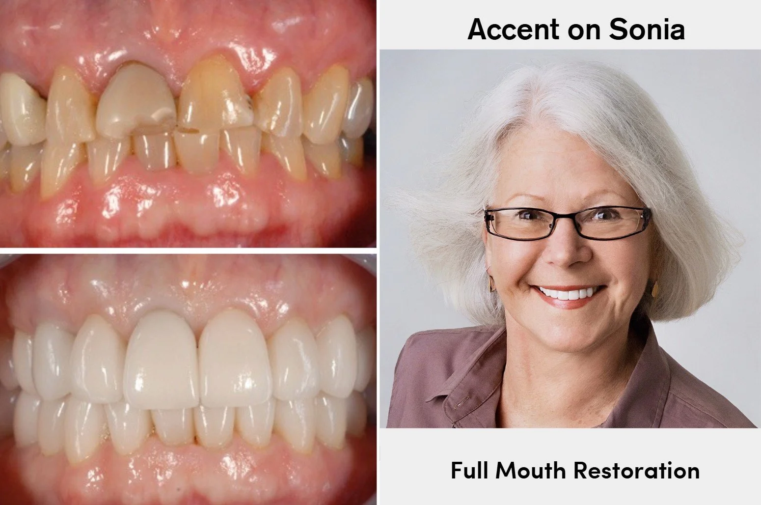 Before and after smile restoration with porcelain dental veneers at Accent Your Dentist in Ponsonby, Auckland, creating a brighter, natural-looking smile.