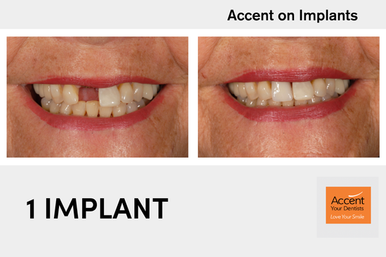Before and after a single dental implant replacing a knocked front tooth at Accent Your Dentist in Ponsonby, Auckland, restoring a natural-looking smile.