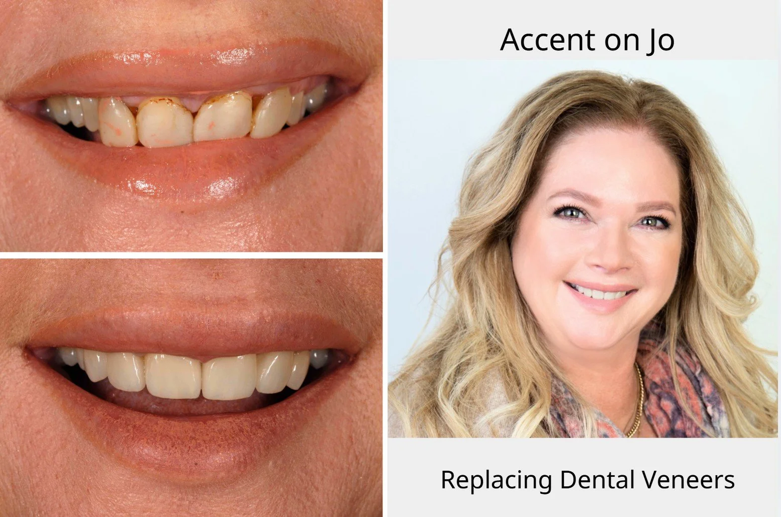 Before and after replacing old composite bonding with porcelain dental veneers at Accent Your Dentist in Ponsonby, Auckland.