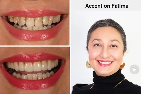 Porcelain Dental Crowns Improving Crooked Teeth
