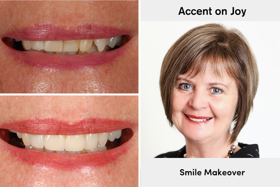 Joy's smile makeover before and after at Accent Your Dentist in Ponsonby, Auckland.