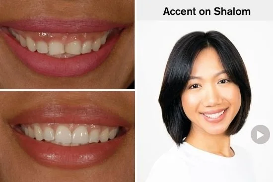 Fix Small Worn Front Teeth