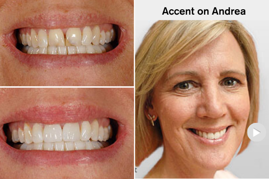 Fix Broken, Discoloured Teeth: Porcelain Dental Crowns
