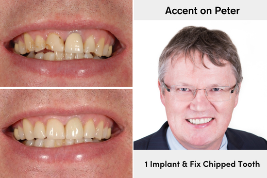 Before and after restoring worn and chipped teeth with custom dental crowns at Accent Your Dentist in Ponsonby, Auckland.