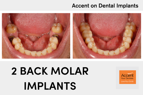 Before and after dental implants replacing damaged back molars at Accent Your Dentist in Ponsonby, Auckland, restoring strength, function and chewing ability.
