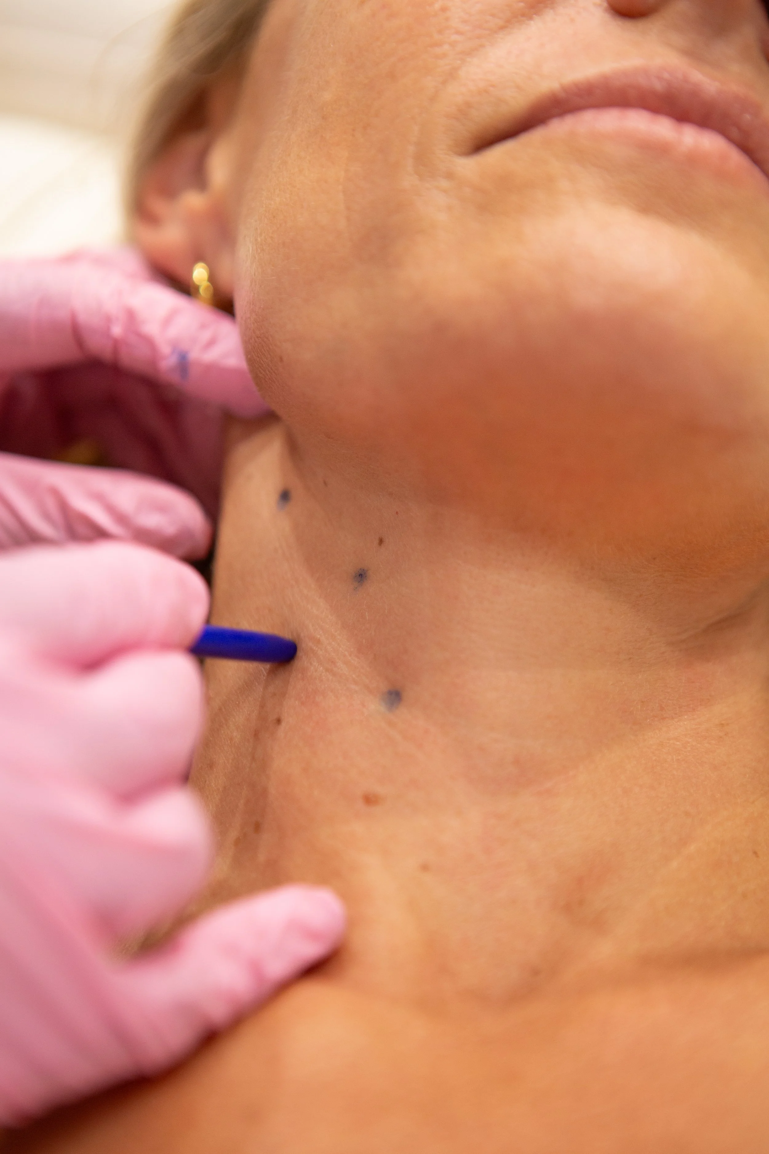 A close-up of a woman's neck with several moles being marked with a blue pen by a medical professional wearing pink gloves.
