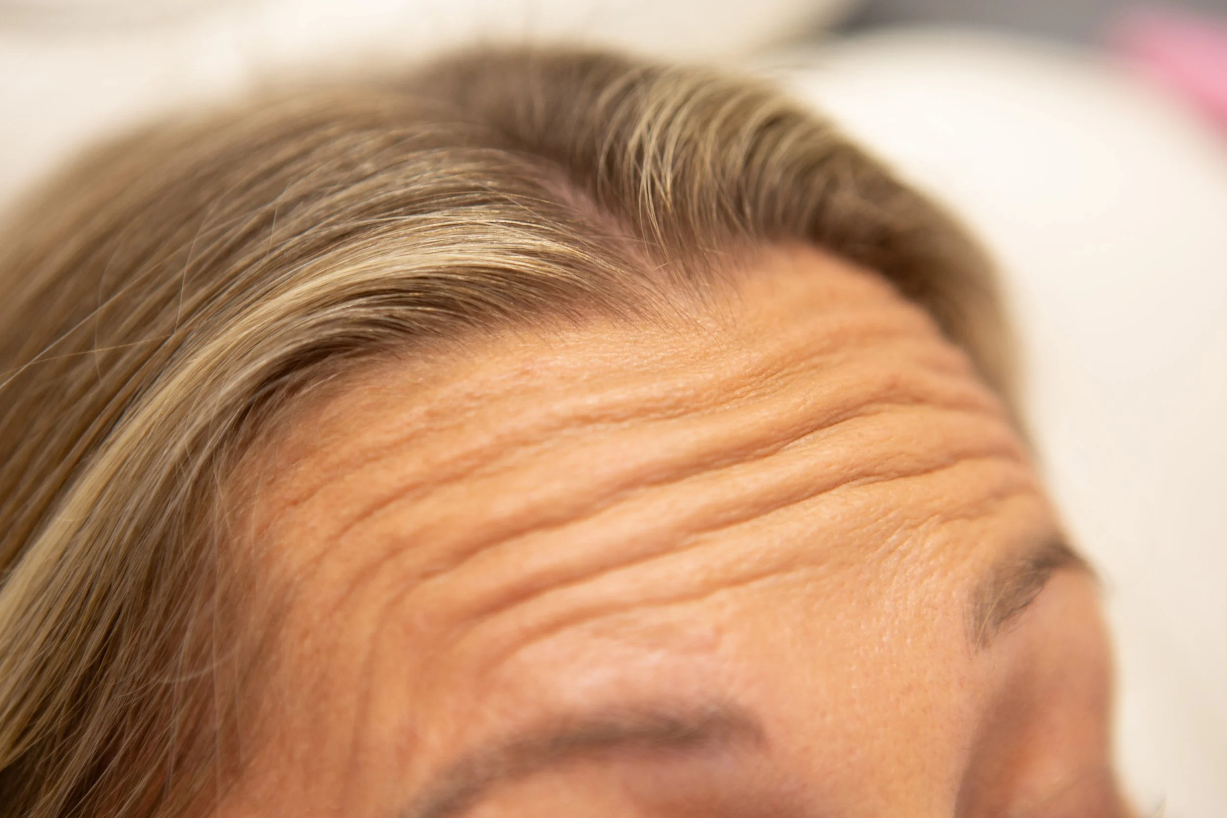 Close-up of a woman's forehead with visible horizontal wrinkles, and blonde hair.