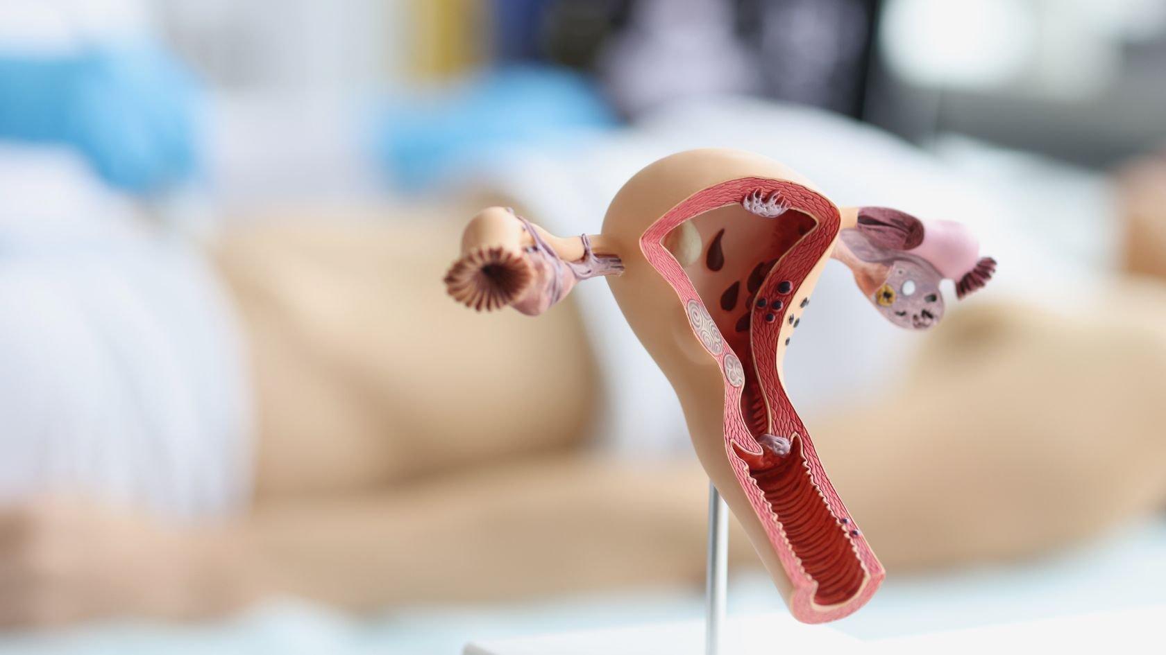 New tests can cut the long wait for an endometriosis diagnosis