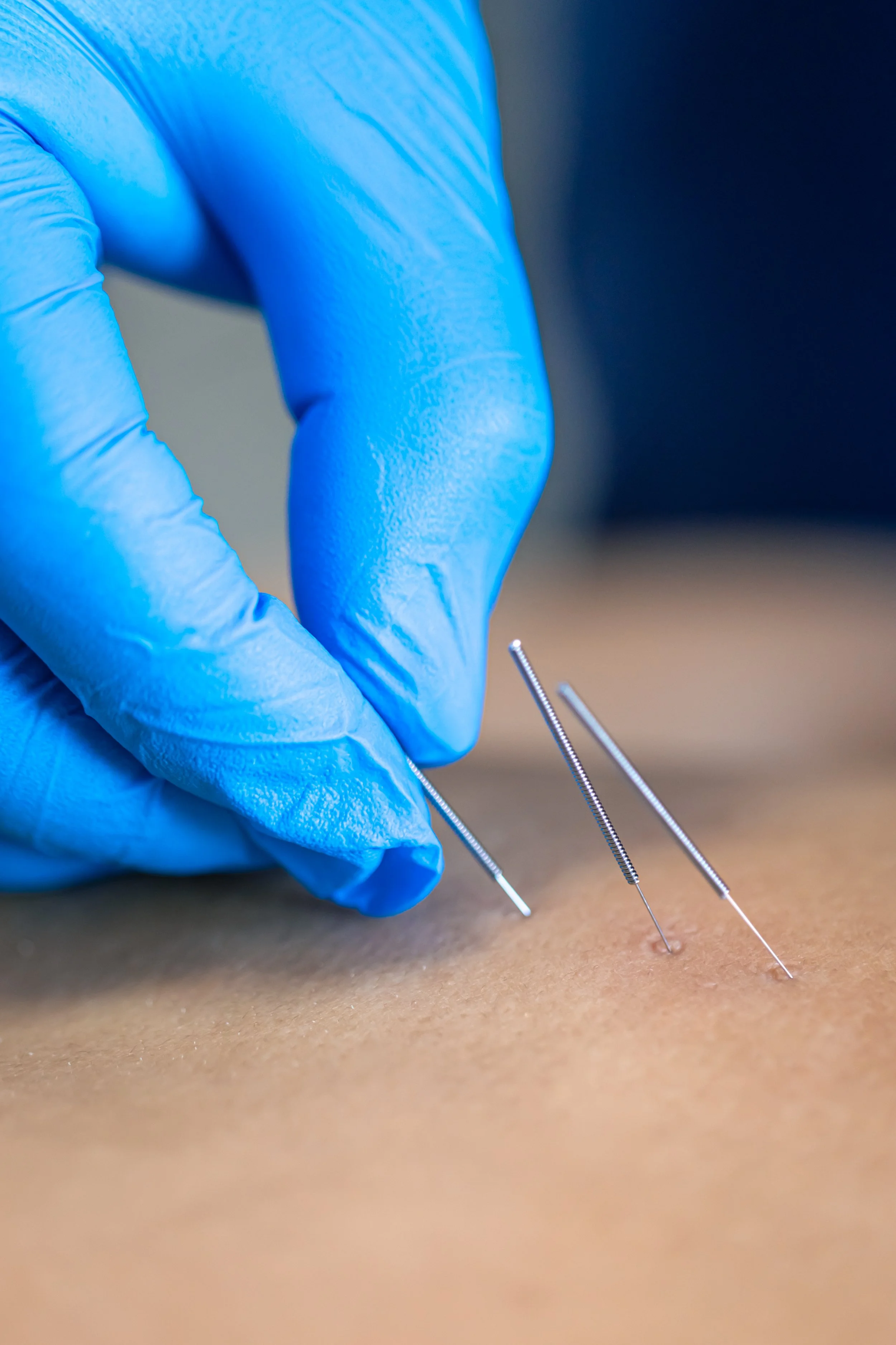 Dry Needling/Instrument Assisted Tissue Mobilization