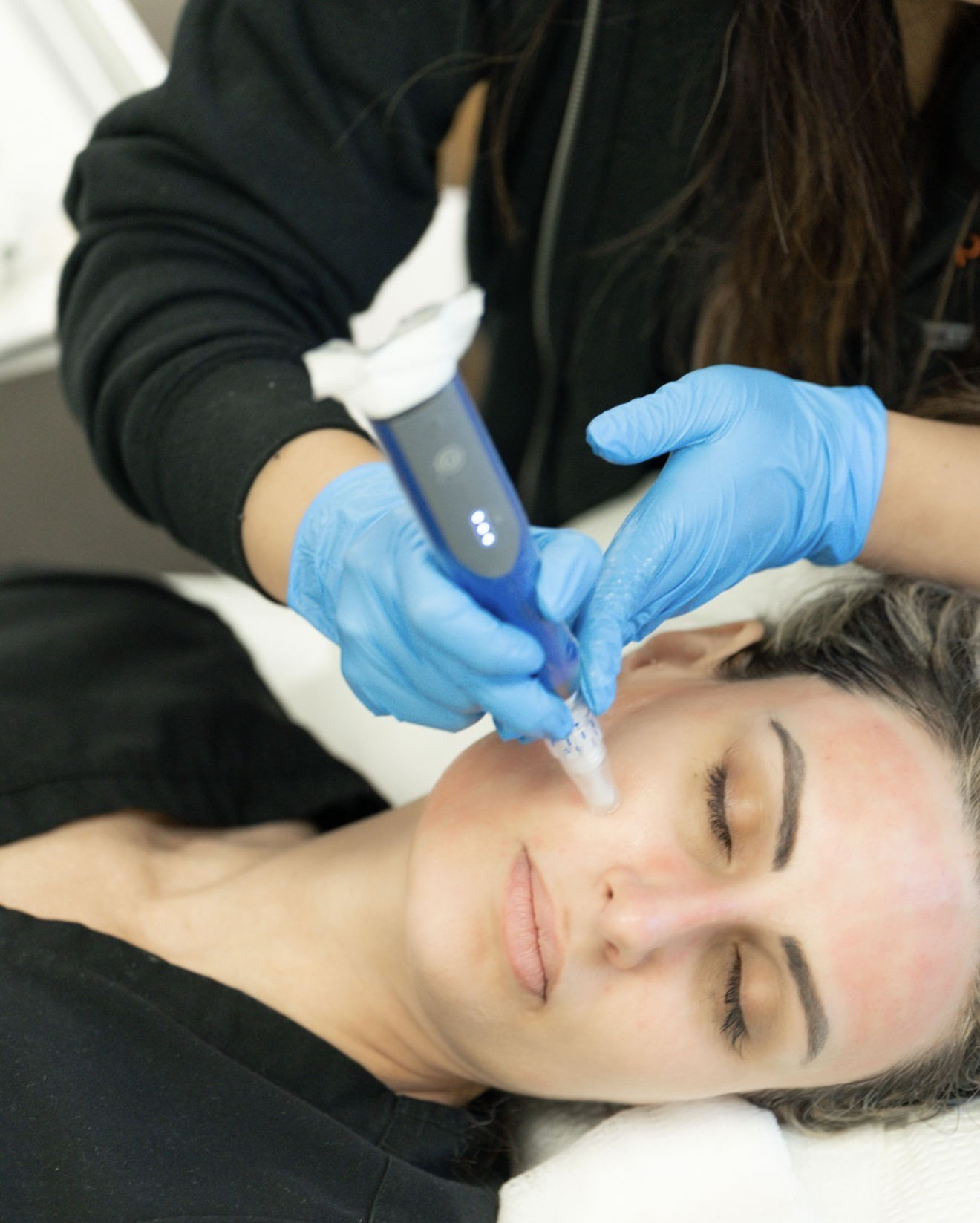 A woman receiving a cosmetic injection into her face while lying down with eyes closed, wearing a black shirt, as a healthcare professional in blue gloves administers the treatment with a syringe.