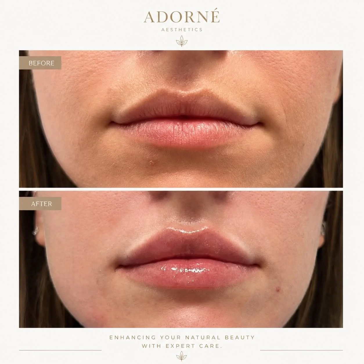 LIP FILLER B AND A.jpg