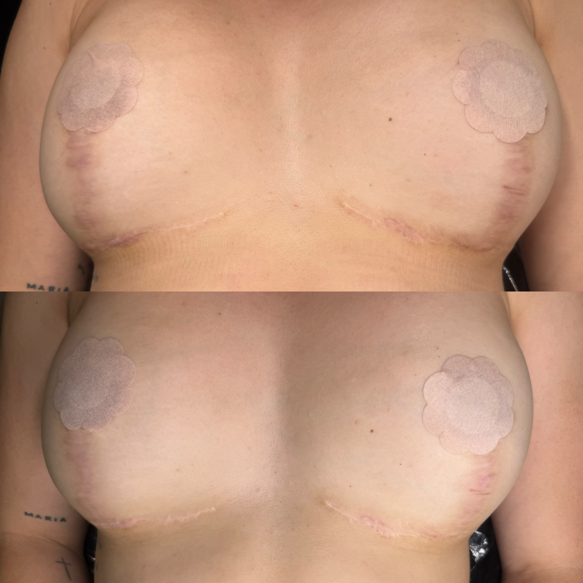 Before and after images of a woman's chest showing hyperpigmented/dark scars having been lightened by pixie powder.