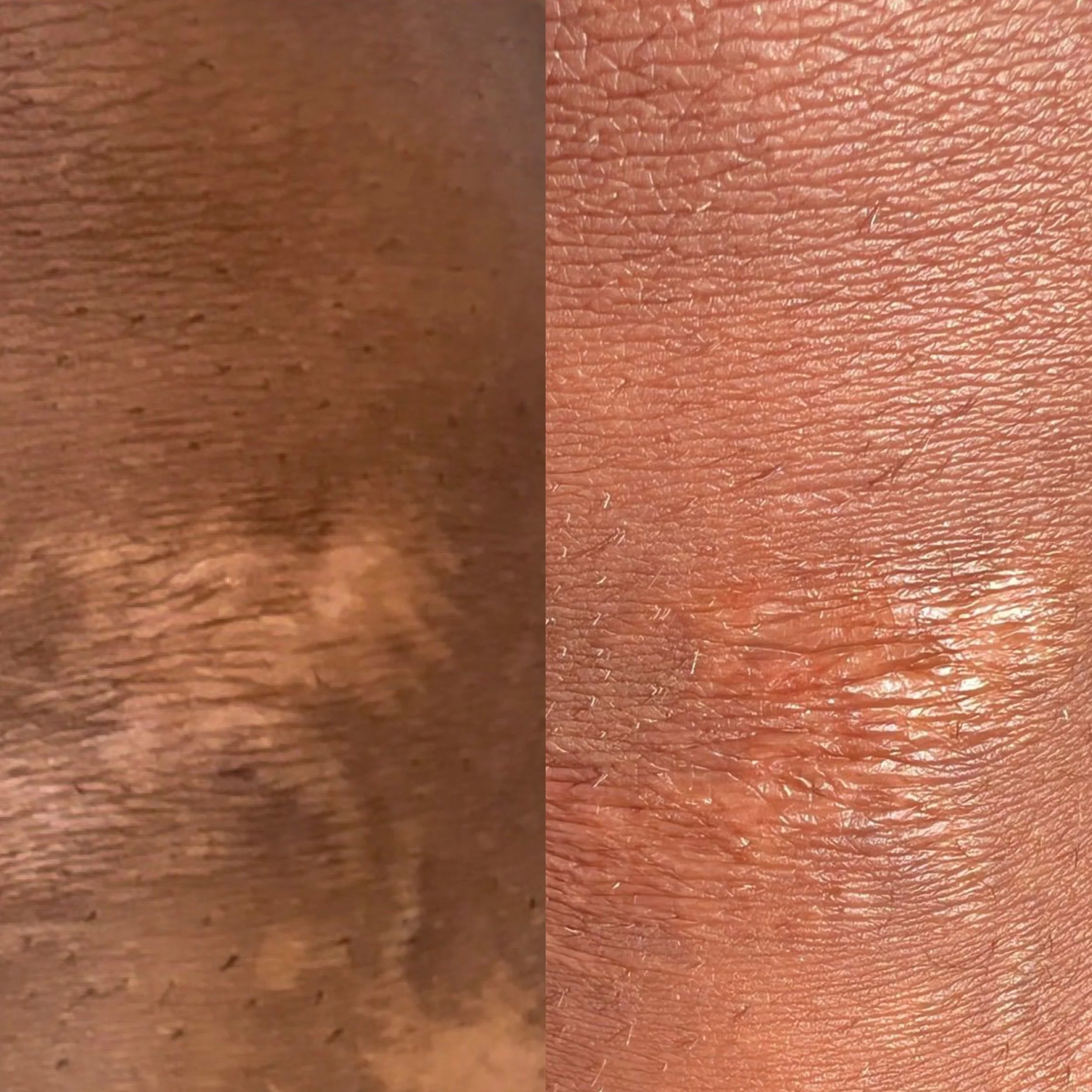 Close-up image showing a side-by-side comparison of before and after camouflage tattoo, with the left side showing more drastic color difference and the right side showing the skin tone being more blended and even.