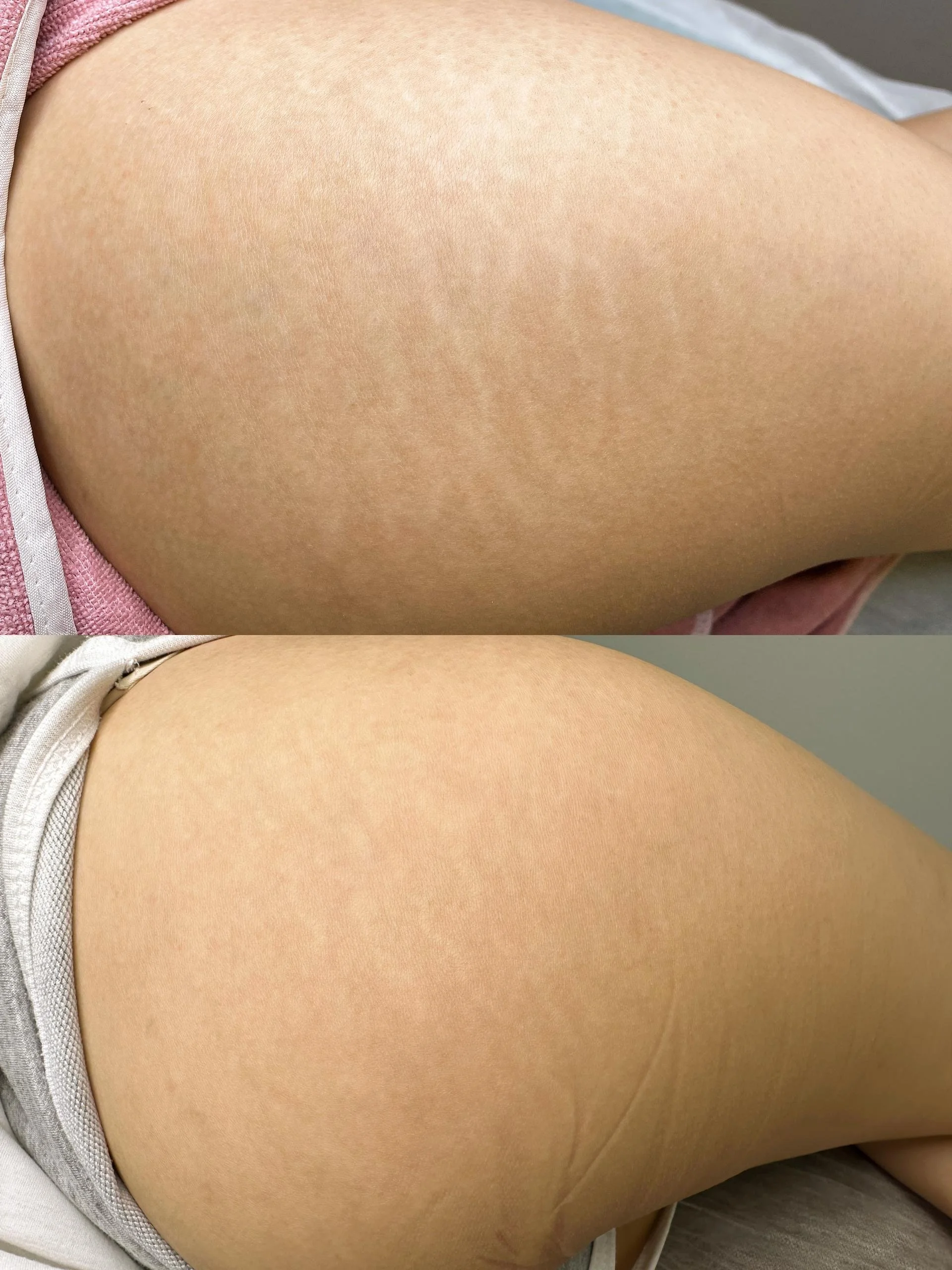 Comparison photo of a person’s thigh before and after inkless revision, showing smoother skin with reduced texture and stretch marks in the second image.