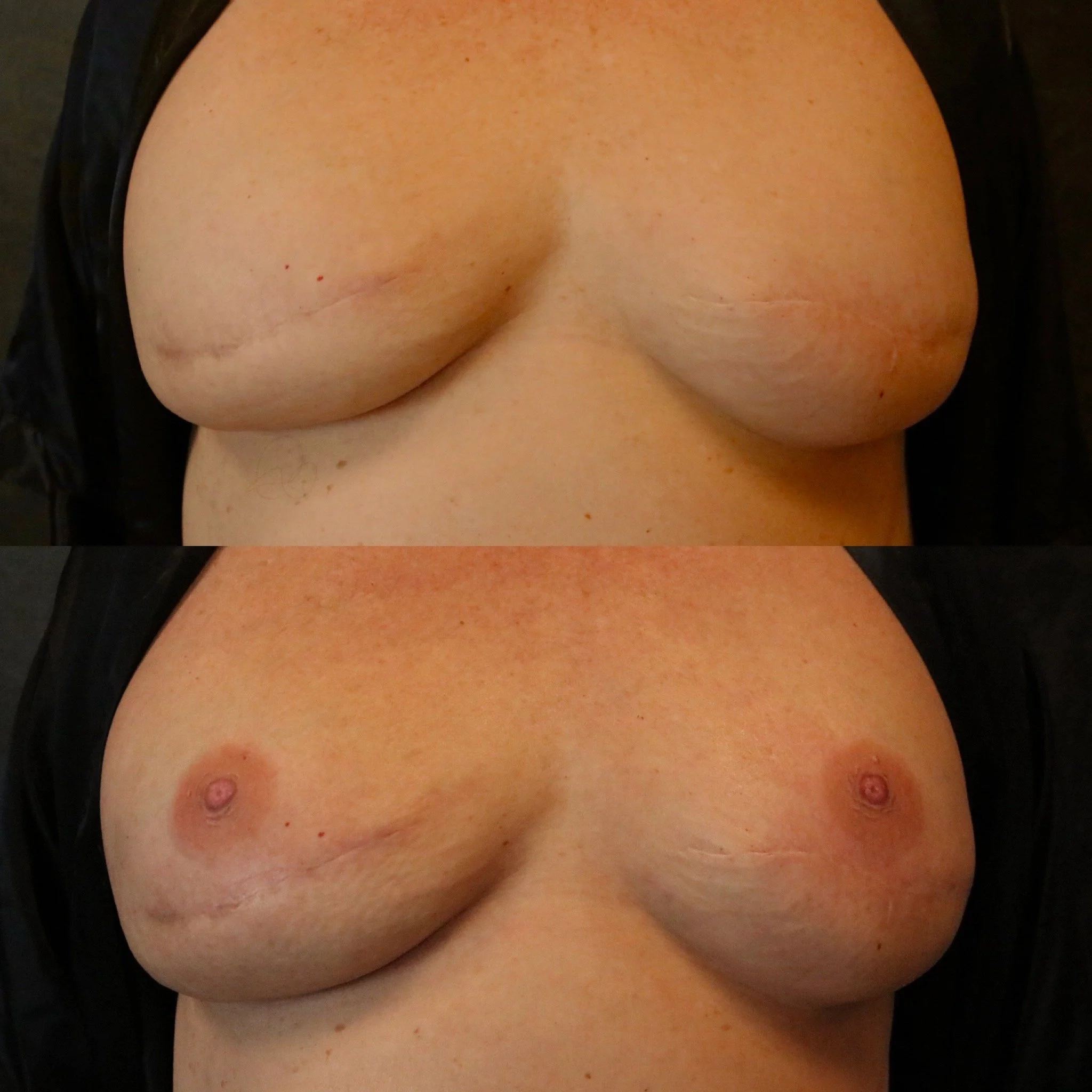 Close-up before and after of a woman's chest who'd had a mastectomy and decided to get 3D areola tattoos.