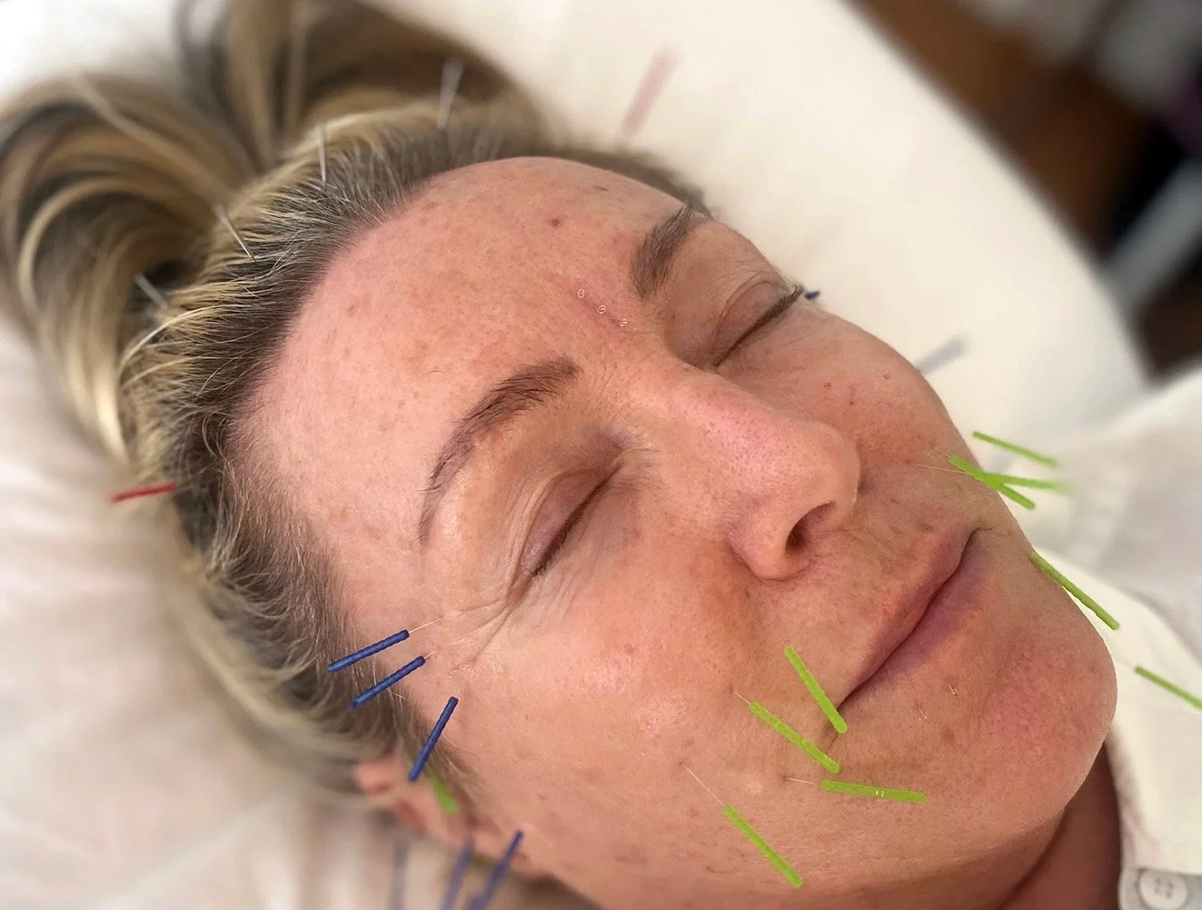 Middle-aged woman undergoing facial acupuncture therapy.