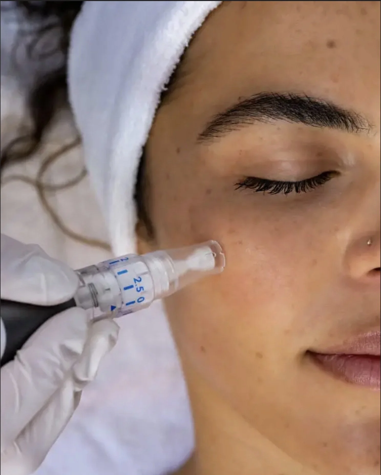 Young woman receiving facial microneedling treatment.