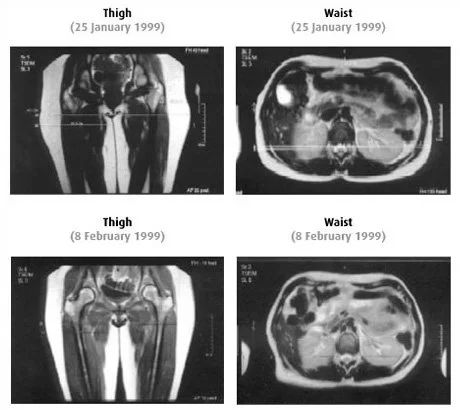 Comparison of MRI scans showing thigh and waist images taken on January 25, 1999, and February 8, 1999.