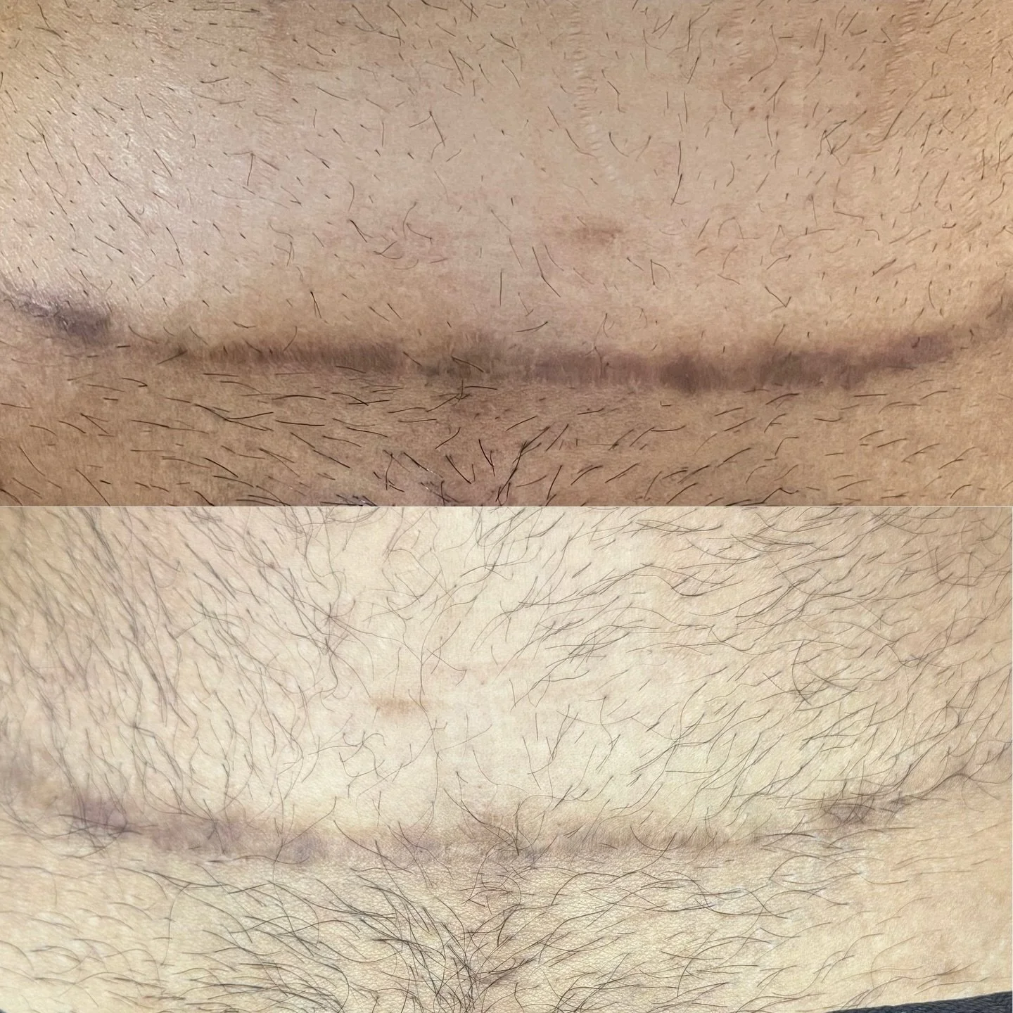 ⸻

Inkless Scar Camouflage ✨

A true process &mdash; but absolutely worth every session.

This result is after 2 sessions focused on:
&bull; Scar lightening
&bull; Texture resurfacing
&bull; Collagen induction

Using a customized serum tailored to yo