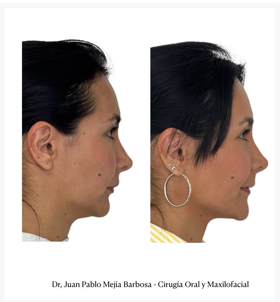 🇨🇴 Cirug&iacute;a Ortogn&aacute;tica 🇨🇴
&bull;
Paciente femenina con alteraci&oacute;n dentofacial Clase II, previamente tratada con ortodoncia y rinoplastia.
✨

Realizamos cirug&iacute;a ortogn&aacute;tica bimaxilar + mentoplastia, junto con una