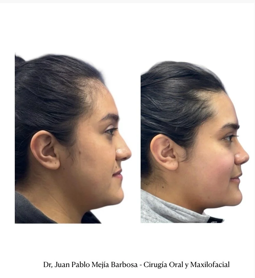 🇨🇴 Cirug&iacute;a Ortognatica 🇨🇴
&bull;
&bull;
Paciente g&eacute;nero femenino con ADF Clase III a quien  le realizamos cirug&iacute;a Ortognatica Bimaxilar + Mentoplastia 👊🏻👊🏻👊🏻🛠️🛠️🛠️
&bull;
&bull;
Mar&iacute;a Alejandra es de lejos la 