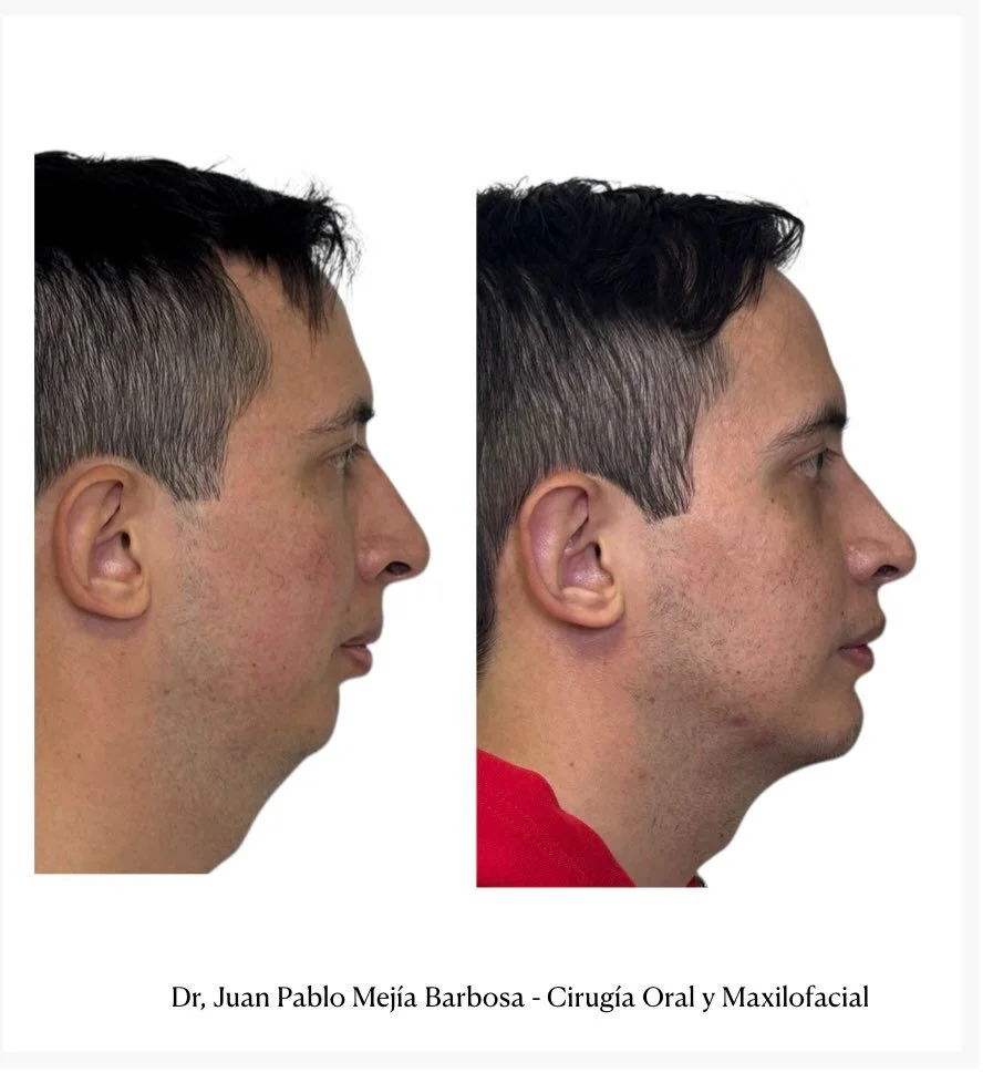 🇨🇴 Cirug&iacute;a Ortognatica 🇨🇴
Cirug&iacute;a Ortogn&aacute;tica para Apnea del Sue&ntilde;o
&bull;
Paciente masculino de 29 a&ntilde;os con deformidad dentofacial clase II y apnea obstructiva del sue&ntilde;o.
&bull;
Realizamos cirug&iacute;a 