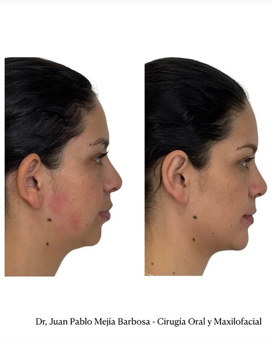 🇨🇴 Cirug&iacute;a Ortognatica 🇨🇴
&bull;
&bull;
Paciente g&eacute;nero femenino con ADF CLASE II y mordida abierta anterior. #openbite 🤓
&bull;
&bull;
Realizamos cirug&iacute;a ortognatica Bimaxilar segmentada y mentoplastia 🧐☺️🤓👊🏻
&bull;
&bu