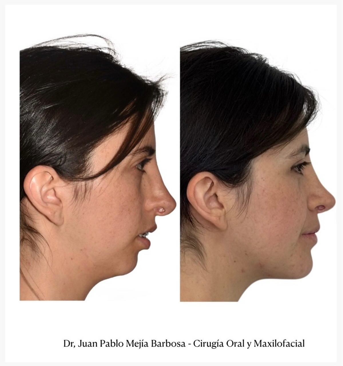 🇨🇴 Cirug&iacute;a Ortognatica 🇨🇴
&bull;
&bull;
Paciente g&eacute;nero femenino con ADF clase II a quien le realizamos cirug&iacute;a Ortognatica Bimaxilar + Mentoplastia 🤓🤓
&bull;
&bull;
@lunaia___  es una s&uacute;per cantante y a las dos sema