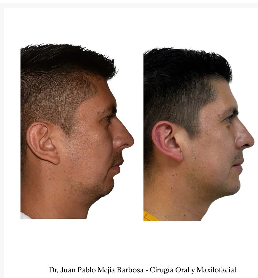 🇨🇴 Cirug&iacute;a Ortognatica 🇨🇴
&bull; 
Paciente g&eacute;nero masculino con ADF clase II Y AOS ( apena del sue&ntilde;o ) 🛌 
&bull;
&bull;
Le realizamos cirug&iacute;a Ortognatica Bimaxilar + Mentoplastia obteniendo muy buenos resultados est&e