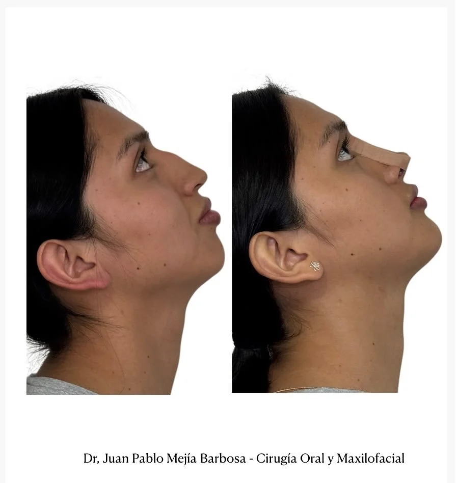 🇨🇴 Feminizaci&oacute;n Facial 🇨🇴
&bull;
&bull;
Paciente G&eacute;nero Femenino en proceso de transici&oacute;n de g&eacute;nero. 🙂
&bull;
&bull;
Se realiza feminizaci&oacute;n facial , mediante Mentoplastia V shape , corticotomia externa mandibu