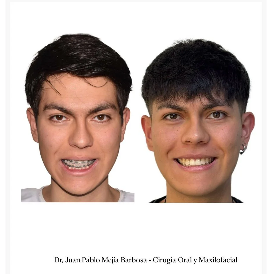 🇨🇴Cirug&iacute;a Ortogn&aacute;tica 🇨🇴
&bull;
Paciente masculino con anomal&iacute;a dentofacial clase III y asimetr&iacute;a facial, quien fue sometido a cirug&iacute;a ortogn&aacute;tica bimaxilar + mentoplastia. 
&bull;
Un procedimiento que no