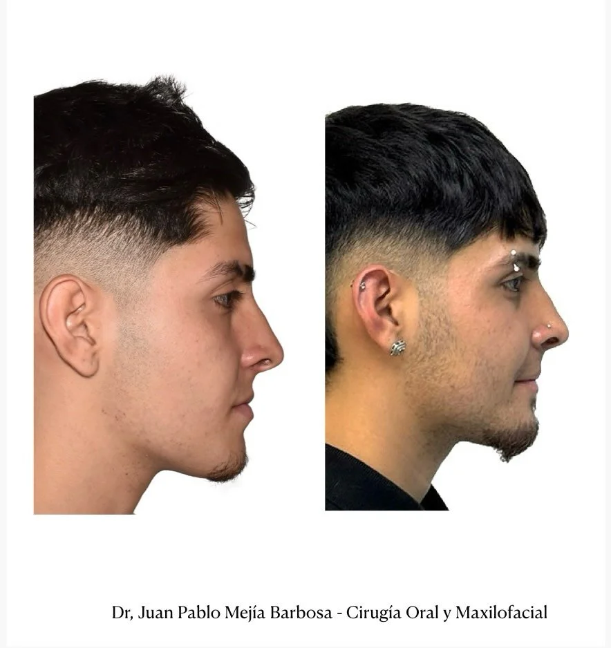 🇨🇴 Cirugia Ortognatica 🇨🇴

Paciente Masculino 18 a&ntilde;os de edad con cuadro cl&iacute;nico de anomal&iacute;a clase III y asimetr&iacute;a facial 🫡
&bull;
&bull;
Realizamos cirug&iacute;a Ortognatica Bimaxilar y a los 3 meses de postoperator
