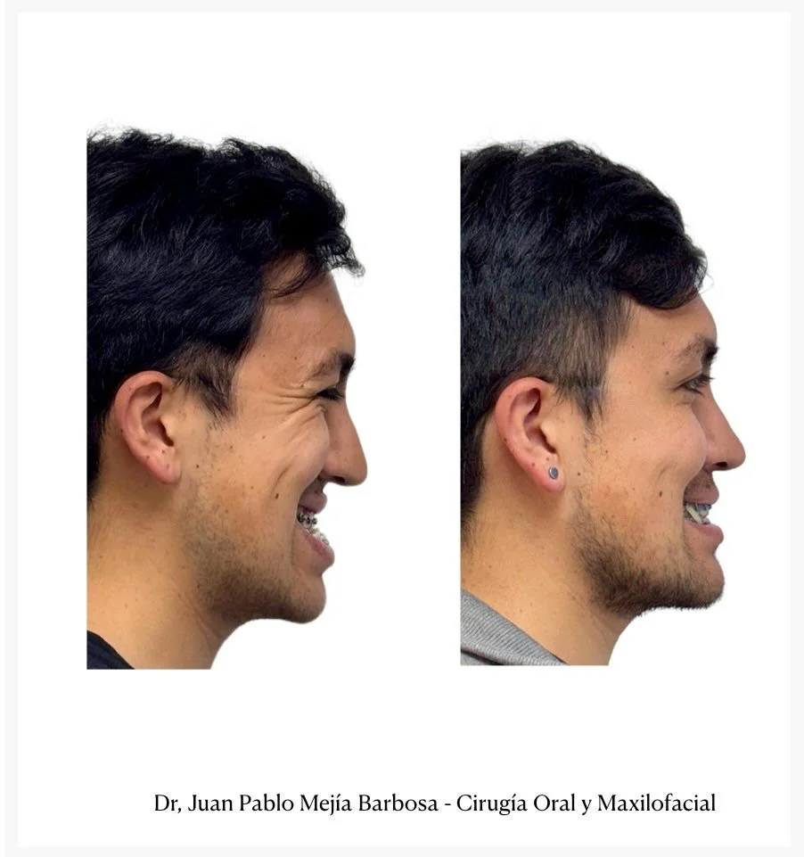 🇨🇴Cirug&iacute;a Ortognatica 🇨🇴
&bull;
&bull;
Juan es un paciente de 24 a&ntilde;os al que hace 7 meses le realizamos cirug&iacute;a Ortognatica Bimaxilar + Mentoplastia 👊🏻
&bull;
&bull;
Ver su cambio y apoyarlo en este proceso me record&oacute