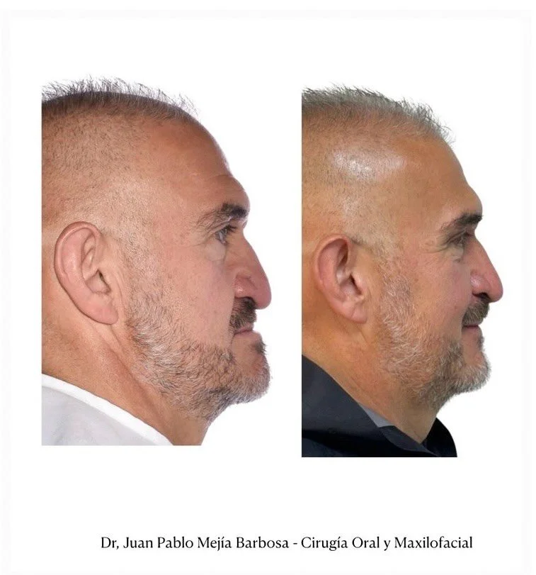 🇨🇴 Cirug&iacute;a Ortognatica 🇨🇴
&bull;
&bull;
Carlos es un paciente masculino con ADF Clase III le realizamos cirug&iacute;a Ortognatica Bimaxilar + Mentoplastia ⚡️⚡️
&bull;
&bull;
A pesar de tener m&uacute;ltiples trabas con su cirug&iacute;a d