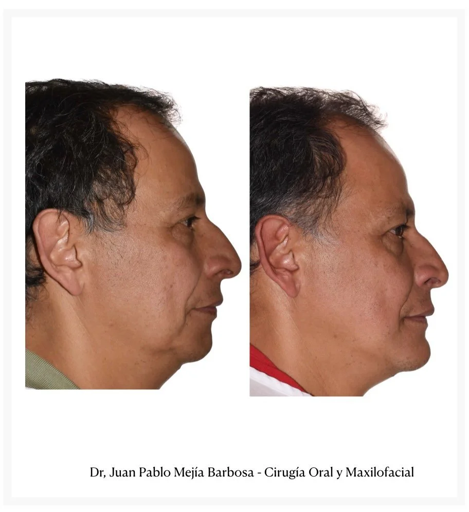 🇨🇴 Cirug&iacute;a Ortognatica 🇨🇴
&bull;
&bull;
Luis es un paciente g&eacute;nero masculino con ADF clase II AOS severo. Se realiz&oacute; cirug&iacute;a Ortognatica Bimaxilar + Mentoplastia. 🫨🫨🫨
&bull;
&bull;
Hay algunos casos que mueven las f