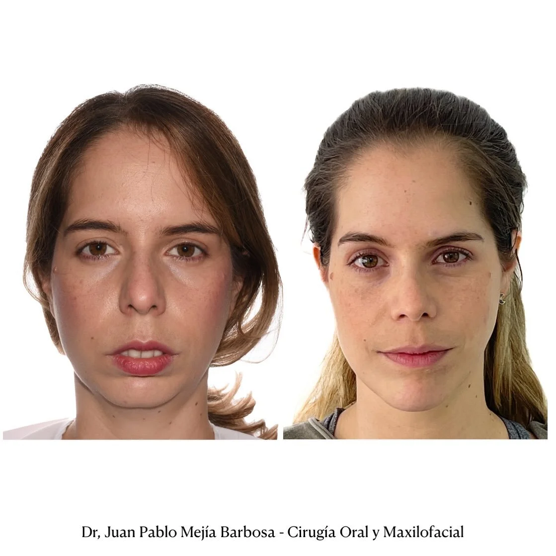 🇨🇴 Cirug&iacute;a Ortognatica 🇨🇴
&bull;
&bull;
Paciente g&eacute;nero femenino con ADF clase II Y AOS. Realizamos cirug&iacute;a Ortognatica Bimaxilar + Mentoplastia y posteriormente Rinoplastia por @dosemedicine_ 👃
&bull;
&bull;
Silvana es de e