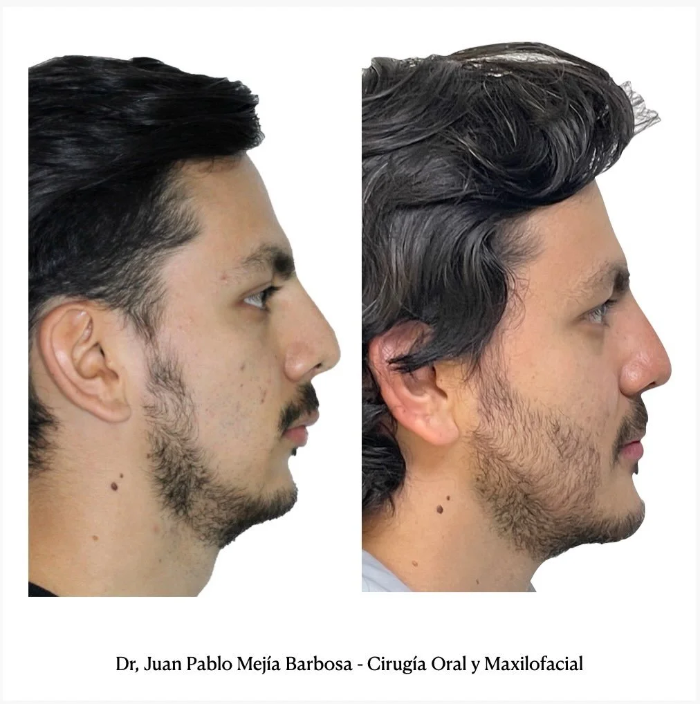 🇨🇴 Cirug&iacute;a Ortognatica 🇨🇴
&bull;
&bull;
Paciente g&eacute;nero masculino con ADF clase II , le realizamos cirug&iacute;a Ortognatica Bimaxilar + Mentoplastia 👊🏻👊🏻👊🏻
&bull;
&bull;
Ricardo lleg&oacute; con nosotros despu&eacute;s de in