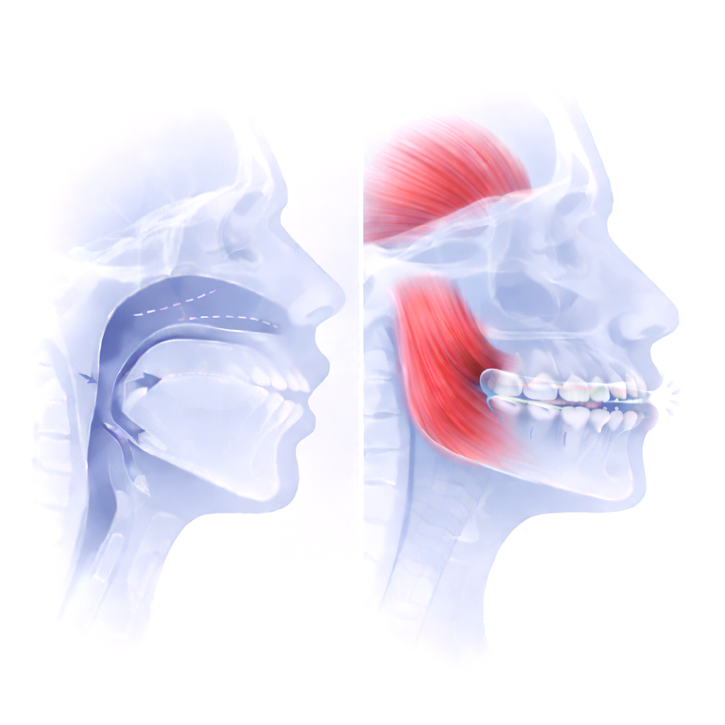 Apnea del Sueño y Bruxismo