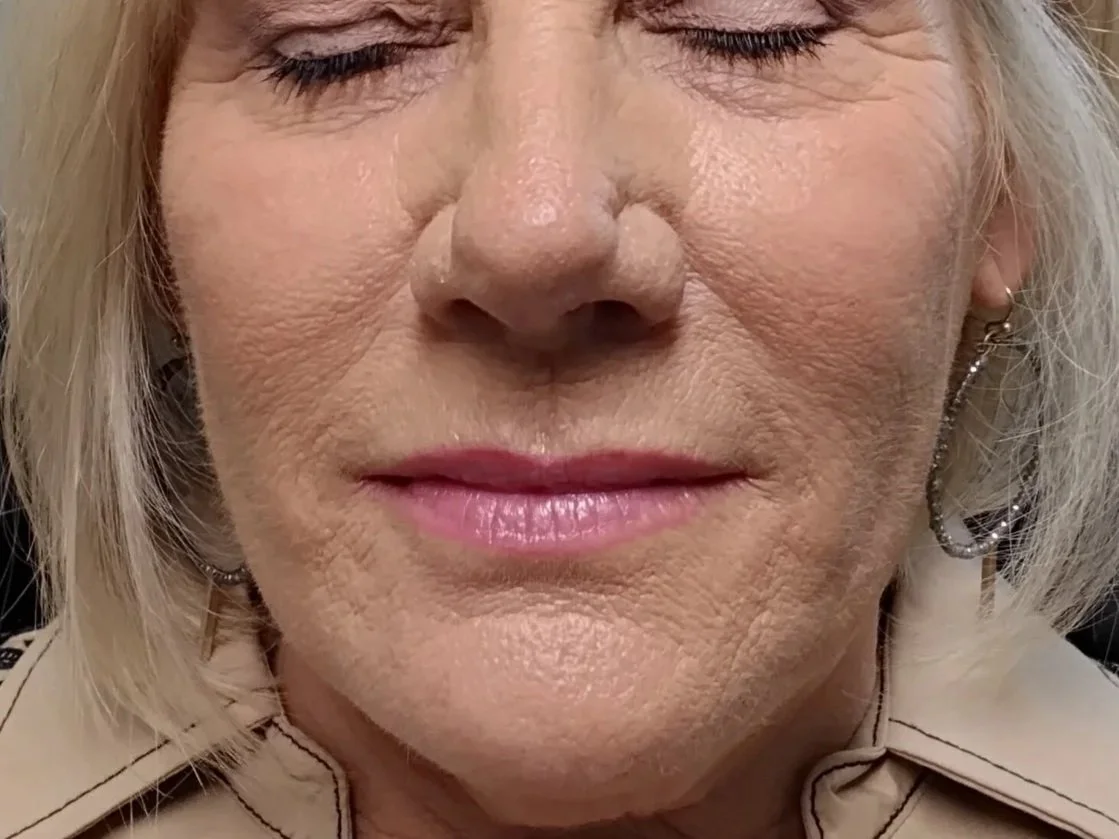 Before Cheeks