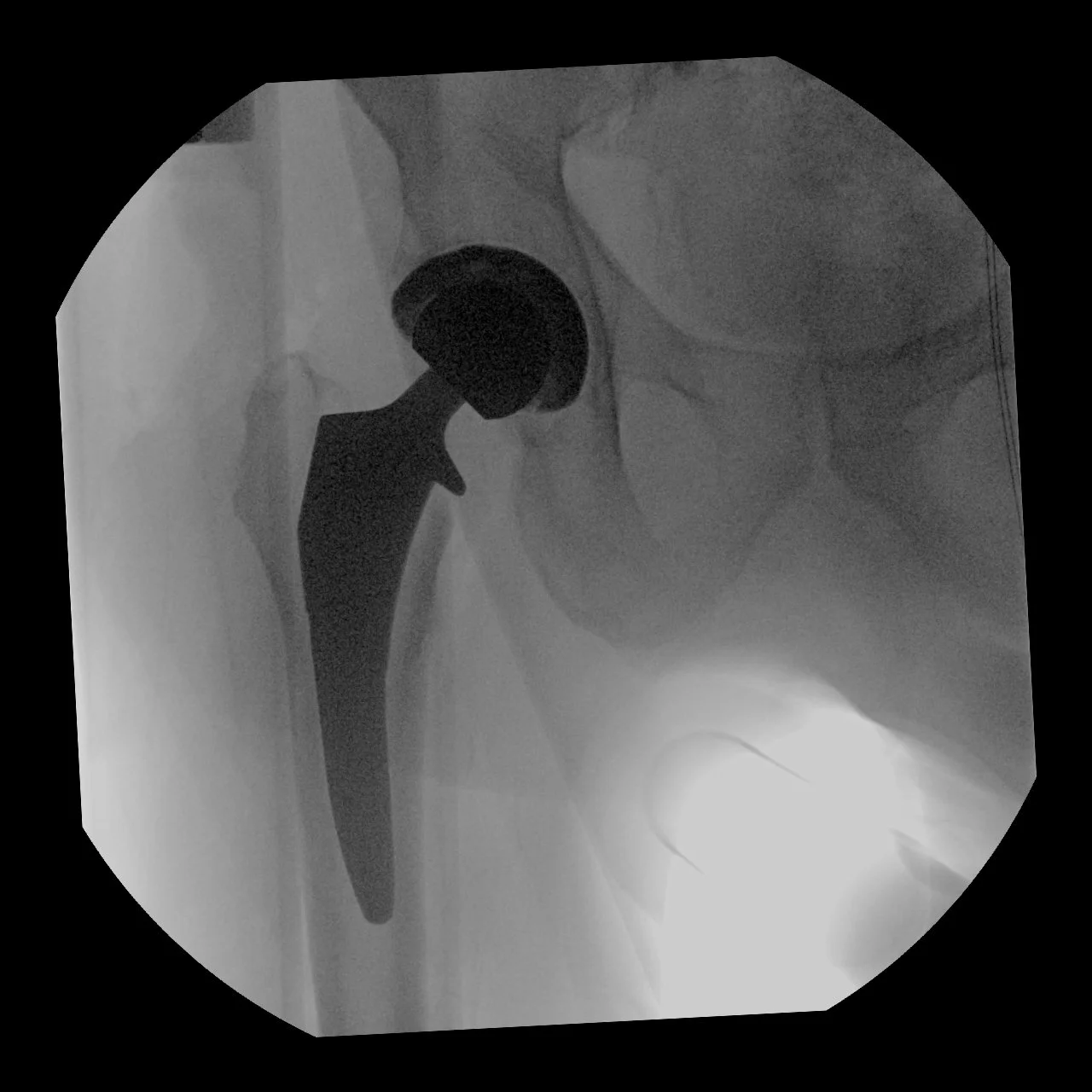 Hip Replacement Recovery Timeline
