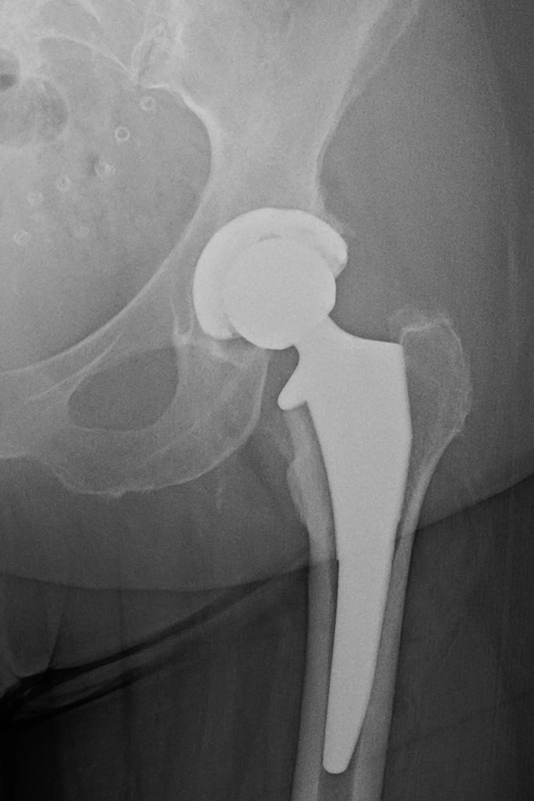 How Long Does Hip Replacement Last?