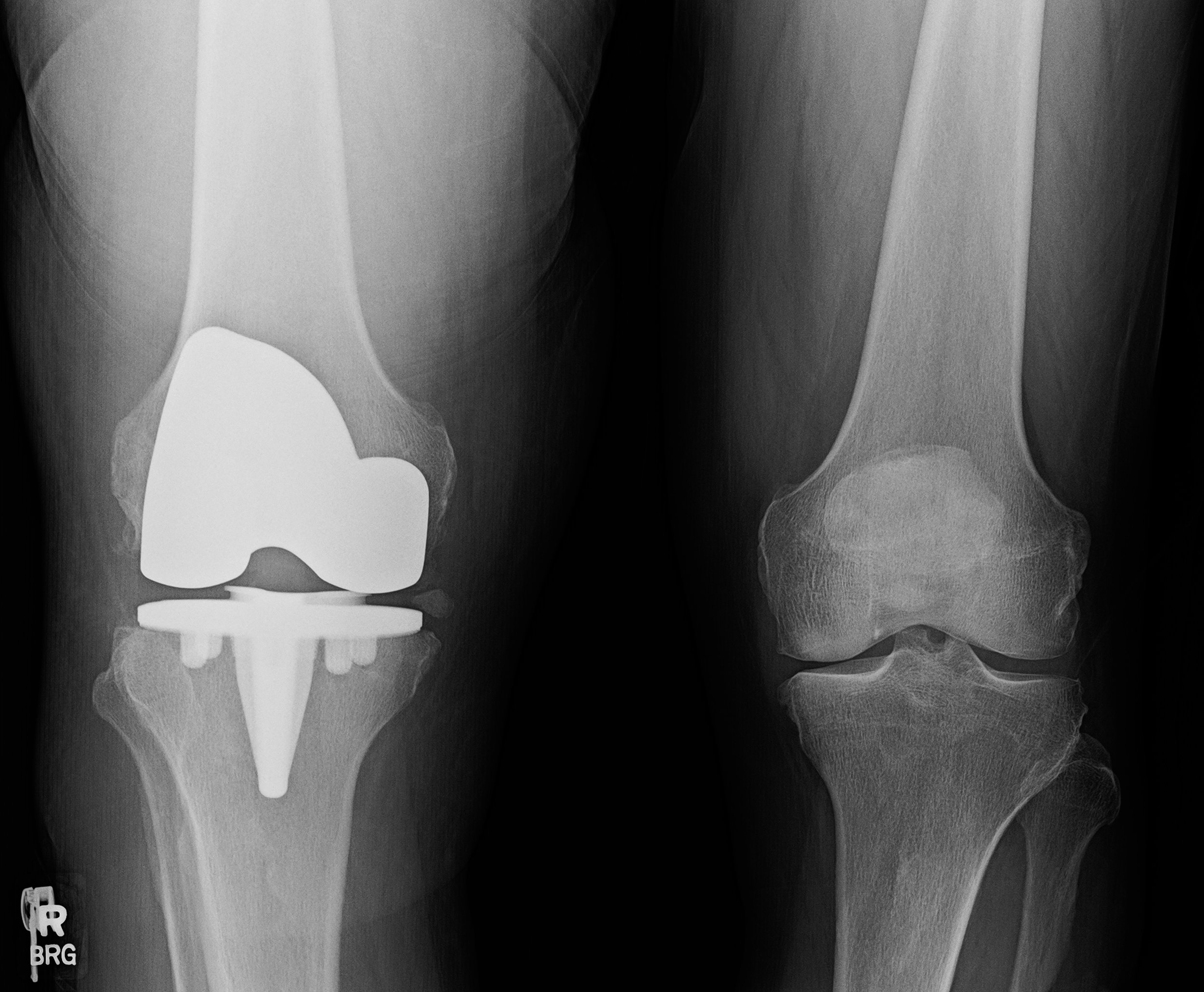 How Painful Is Knee Replacement?
