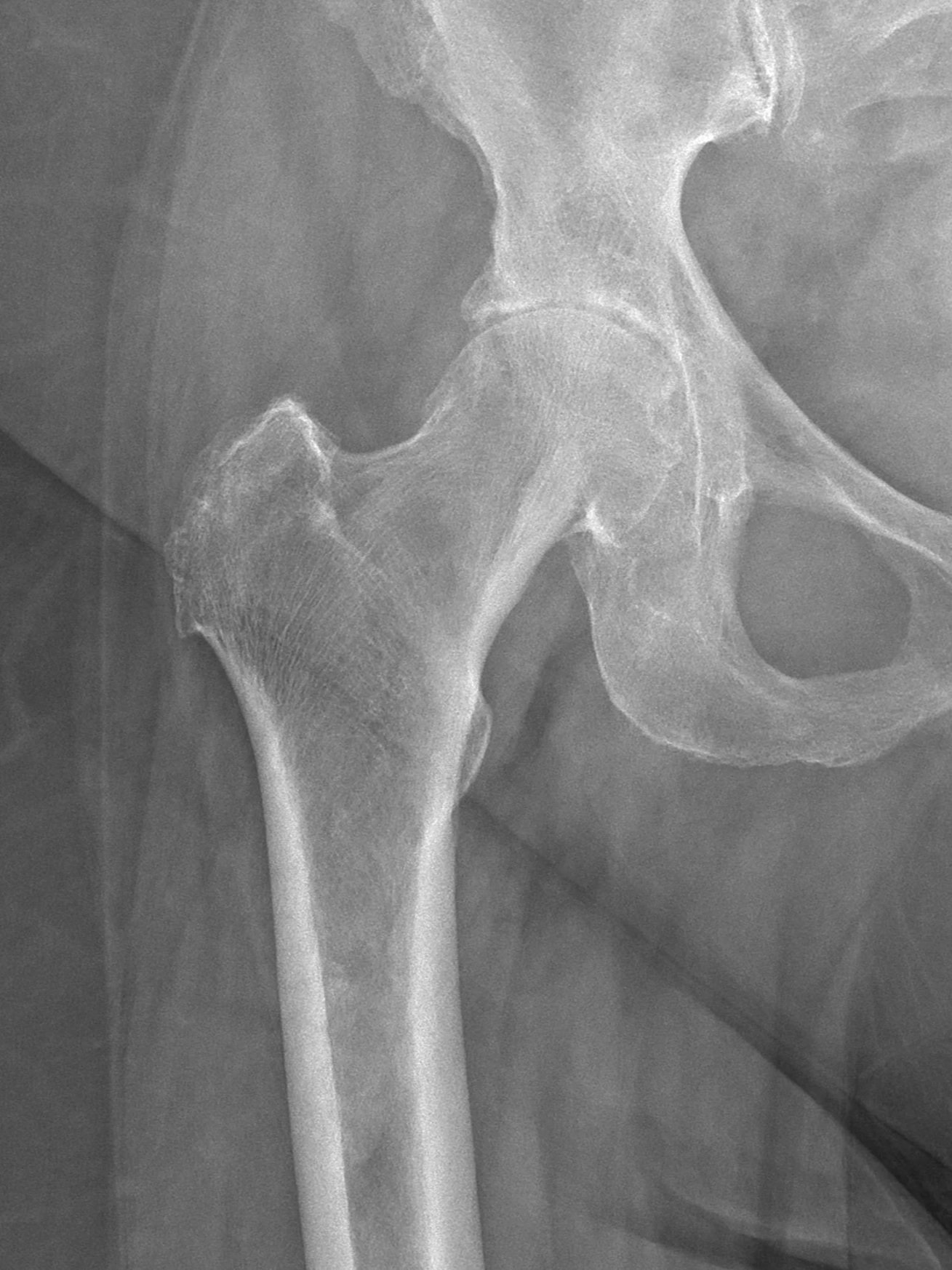 When Is a Hip Replacement Appropriate?