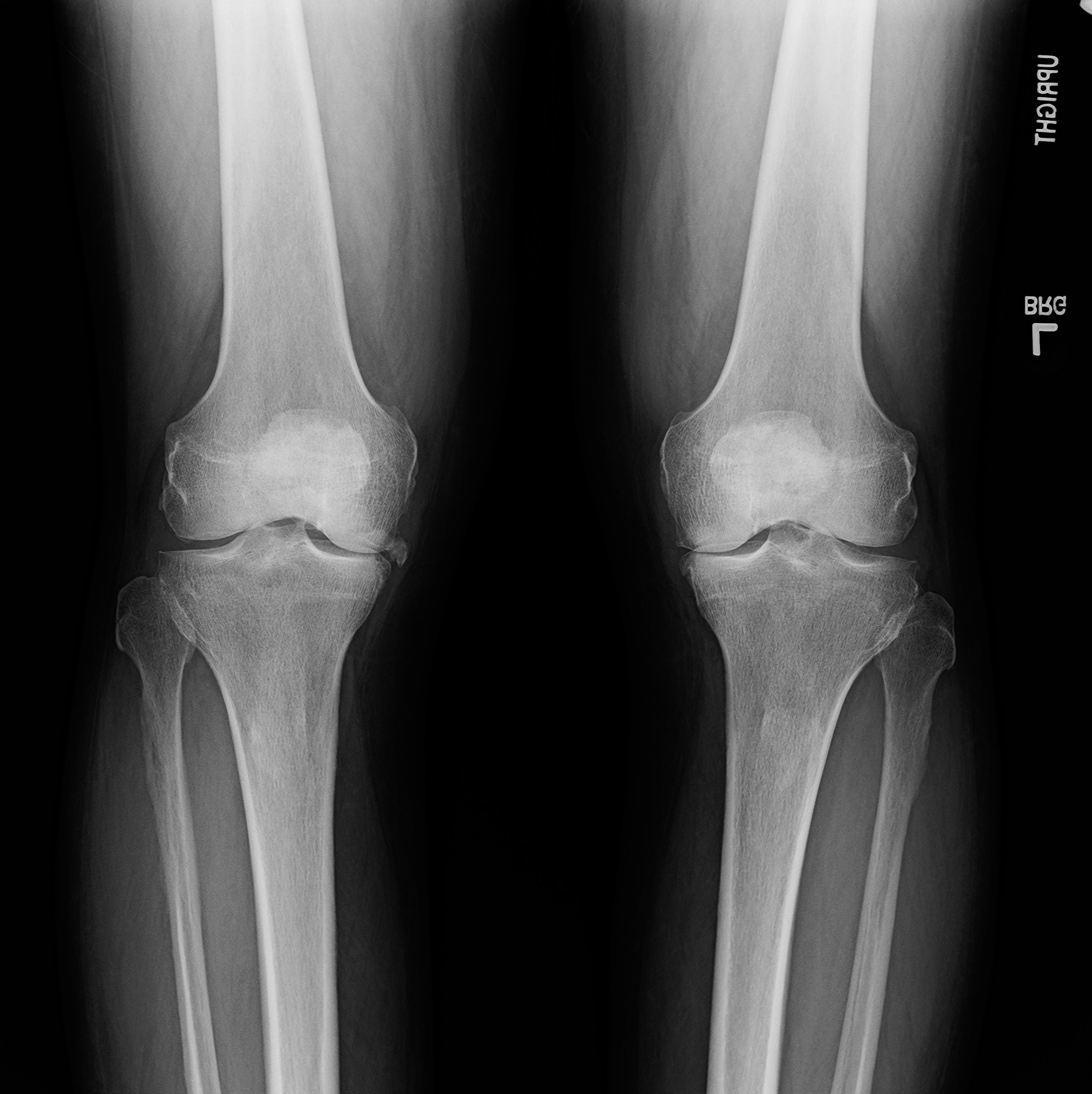 What Is the Recovery Timeline After Knee Replacement?