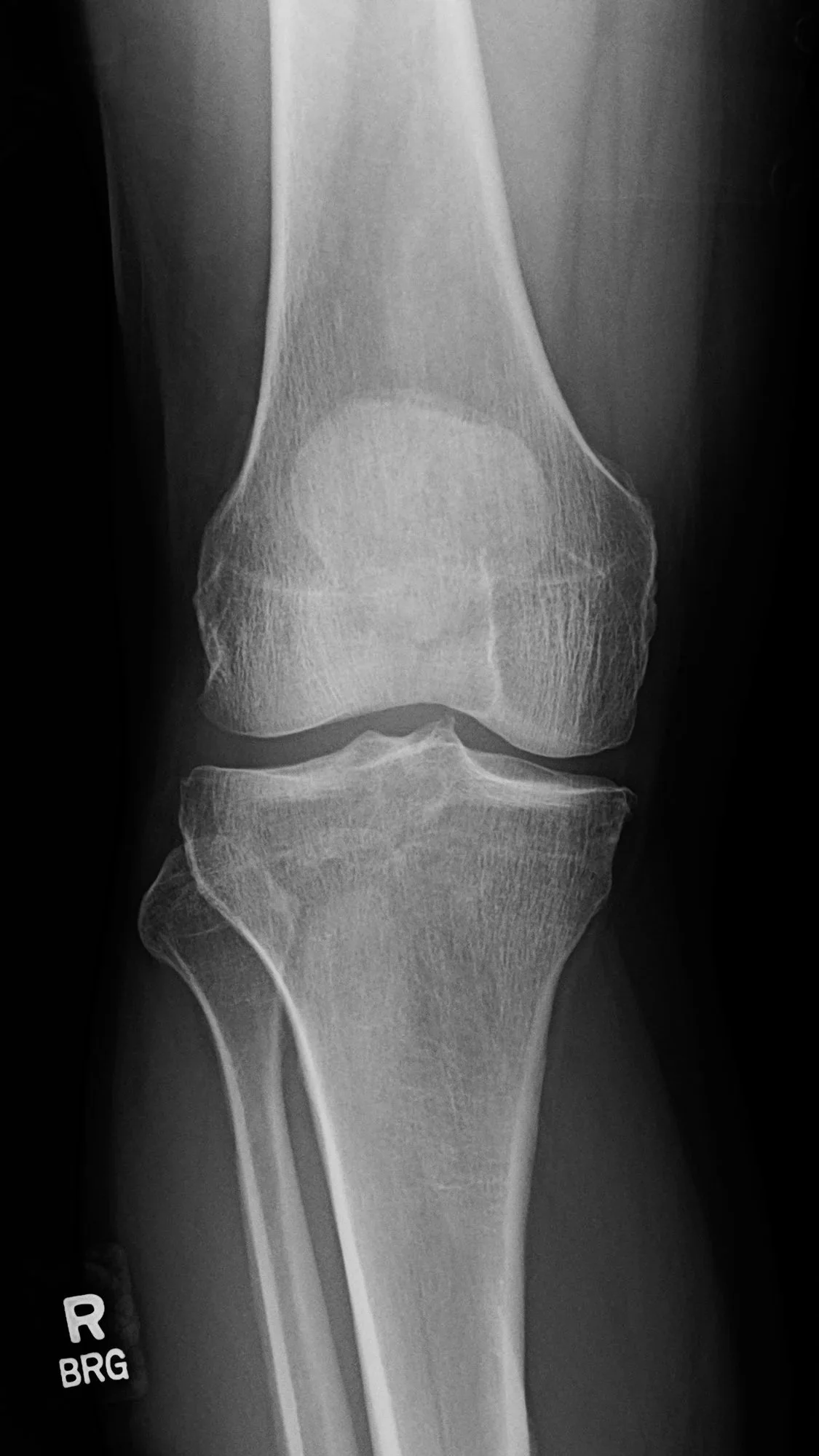 When Should You See a Surgeon for Knee Pain?